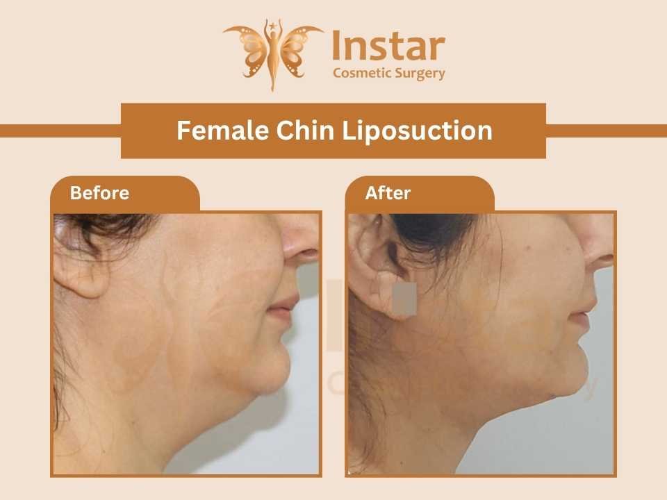 Female double chin-liposuction-1